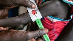 Children in Southern African nations are facing severe acute malnutrition.